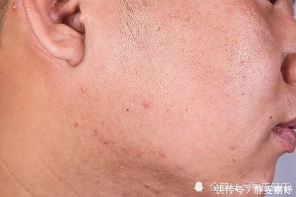 湿气|脸上长出白色的“小米粒”是什么?千万别扣,教你一招,轻松祛除