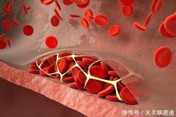 血栓|有脑血栓的人,起床会有2个“怪象”若没有,恭喜离脑梗还远