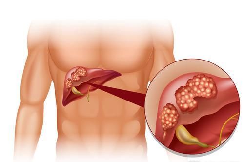 为什么体检肝功能正常，结果却查出肝癌？这次给你解释清楚