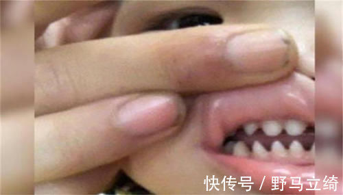乳牙|儿子长了一口“鲨鱼牙”,妈妈连忙送医,医生无知害了孩子