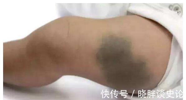 小女孩|宝宝的胎记怎么来的?产科医生:孕期这2种行为易长胎记,要避开