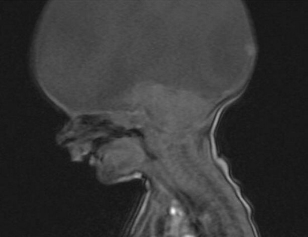 医生|男孩天生无大脑,医生断言很难存活,他的父母却让奇迹出现了