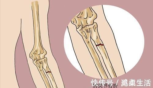 补钙|女人迈入更年期，容易被3种骨病“缠上”，有哪些方法能预防？