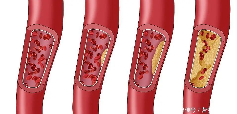 胰岛素|睡觉时,经常出现4种异常,十有八九血糖过高了,需严防并发症