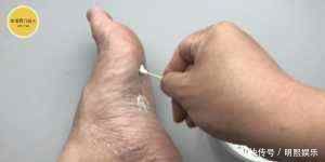 阿司匹林加牙膏,作用好厉害,解决了好多人一大困扰,告知家里人