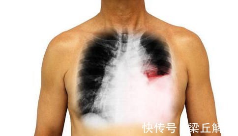 症状|有些症状不可忽视,可能是肺癌的肺外表现,早诊断早治疗痛苦小