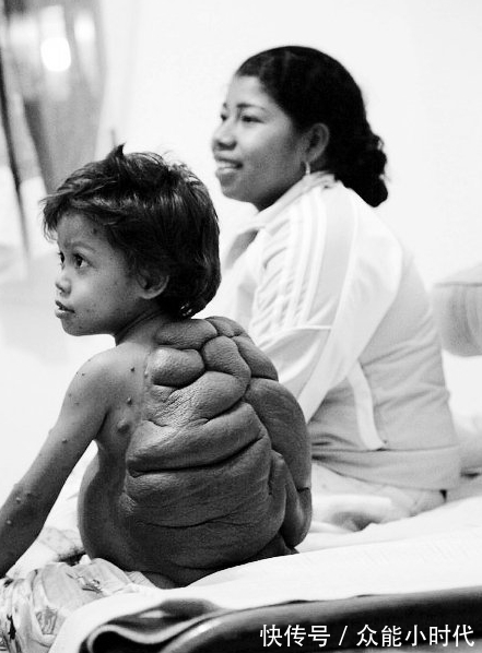 男孩|8岁男孩背上长出惊人大“龟壳”,酷似忍者神龟