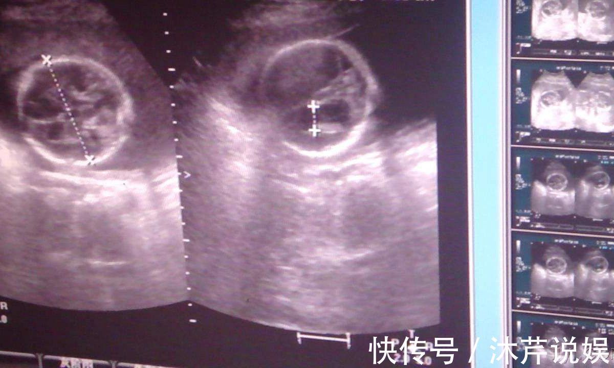 尿液|胎儿在母亲肚子里,生活的很“精致”!不过他的大小便都去哪了