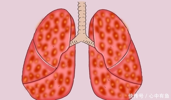 答案|肺癌晚期，吃靶向药时，会不会出现不耐药？医生给出明确答案