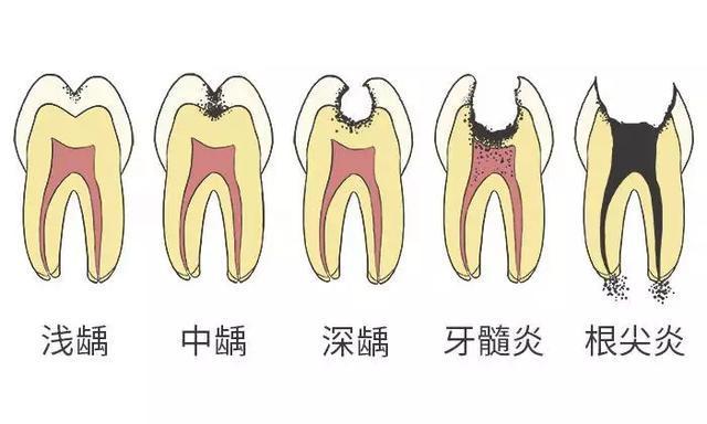恒牙|4岁男孩牙齿几乎全黑6岁前,不要让孩子自己刷牙!