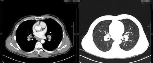 吸烟|得了肺结节到底意味着什么?肺结节用不用手术切除,医生这么说的