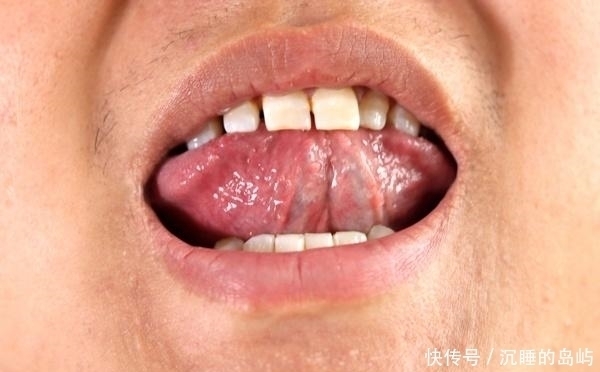舌头|身体出了问题，舌下“青筋”会告诉你，这几个信号多注意