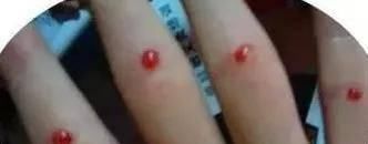 四缝穴，扎一次见效，二次痊愈，真是绝了