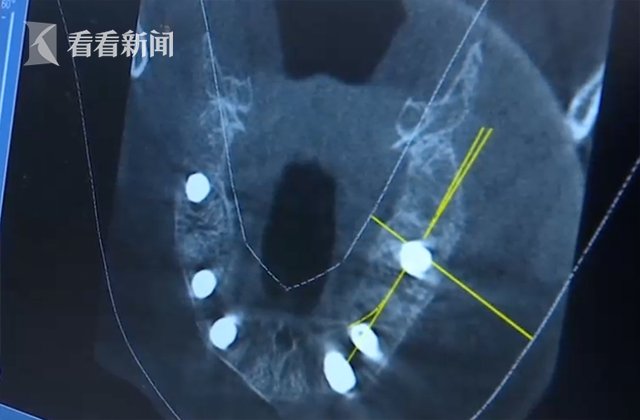男子|32岁男子牙齿几乎都掉光！医生：这病很多人都有