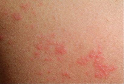 皮肤过敏|皮肤都很脆弱,过敏说来就来,远离它注意以下几点!