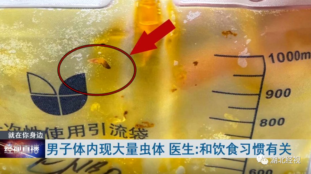 佳木斯|男子体内出现大量活寄生虫!和这种饮食习惯有关