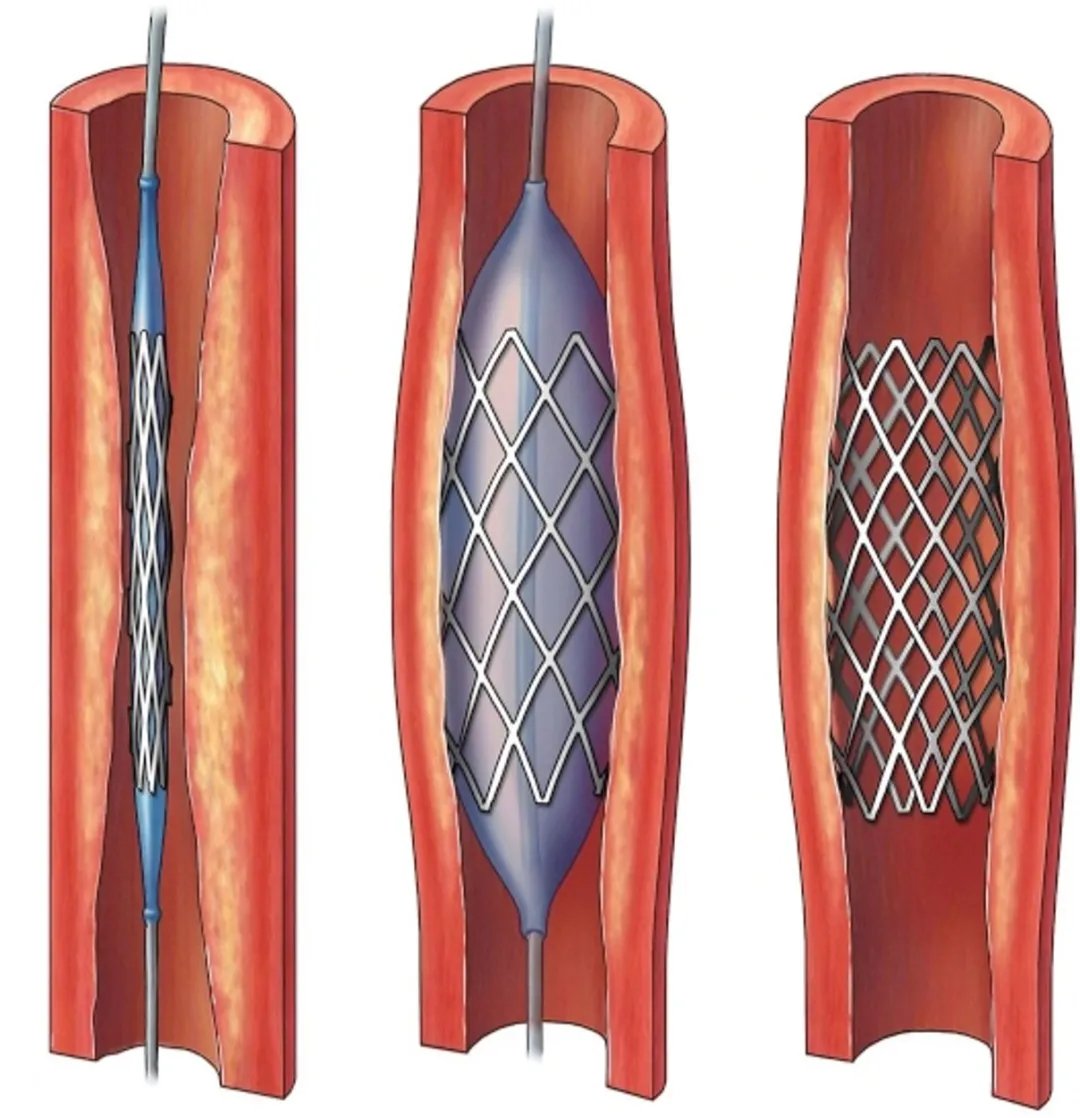 起搏器|“心门”坏了、冠脉堵塞、心脏乱跳,一根导管解决诸多心脏顽疾