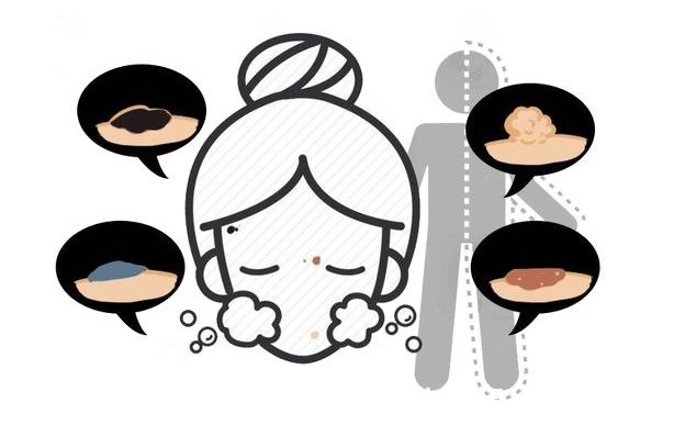 分子|哪种“痣”是危险分子？医生提醒：长在这3处的痣，要格外当心