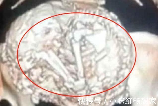 胎儿|老人91岁才发现怀孕,胎儿在肚里已待61年,网友地表最强钉子户