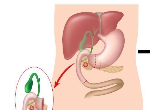 胆结石|“胰腺癌”容易发生在这6类人身上,若出现这3个特征,需警惕