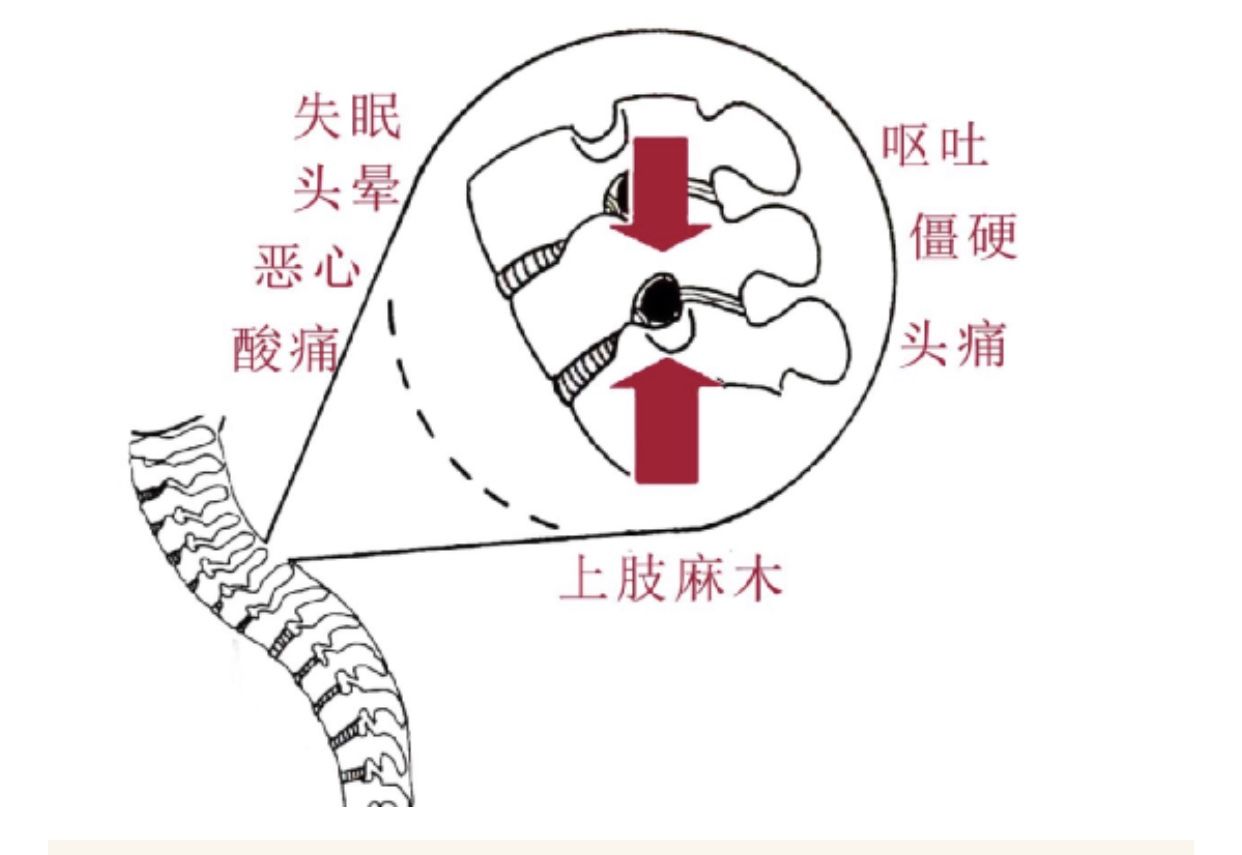 折磨|被颈椎病折磨了两年，才知道中医疗法安全又高效