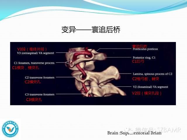 mr|椎-基底动脉系统解剖