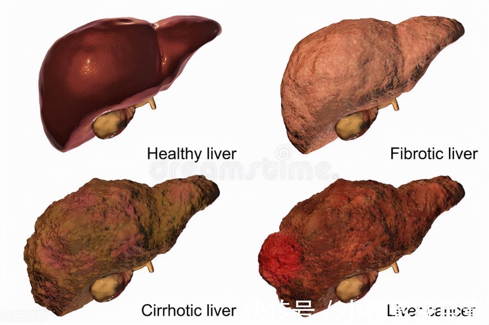 患者|45岁男子被确诊肝癌离世,医生含泪劝告:这种生活习惯一定要改掉