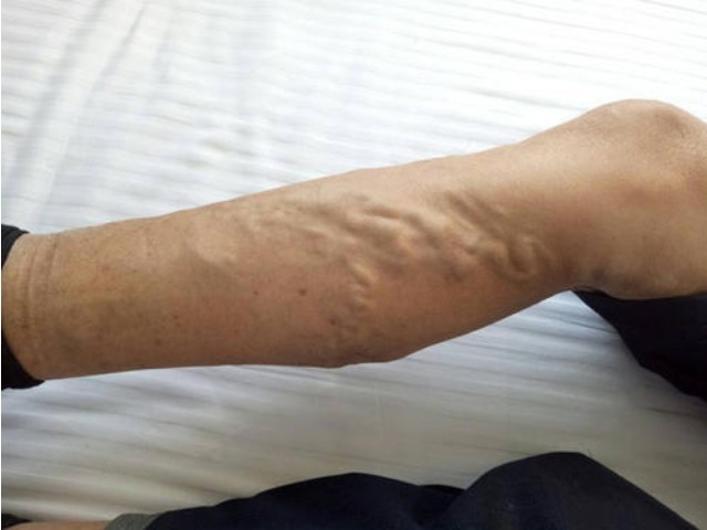 洗腿|58岁的大妈坚持用它来洗腿,竟逆转了静脉曲张,不用去做手术了