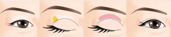 蕾丝 别再贴双眼皮贴啦,眼皮下垂不可逆|医美科普!