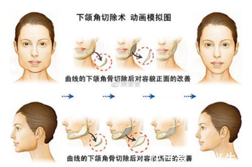 下颌角|关于下颌角手术，大家都会担心后遗症有哪些？有后遗症应该怎么办？