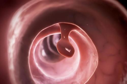 癌变率|实用!息肉一定会癌变吗?肿瘤医院的专家们告诉你答案