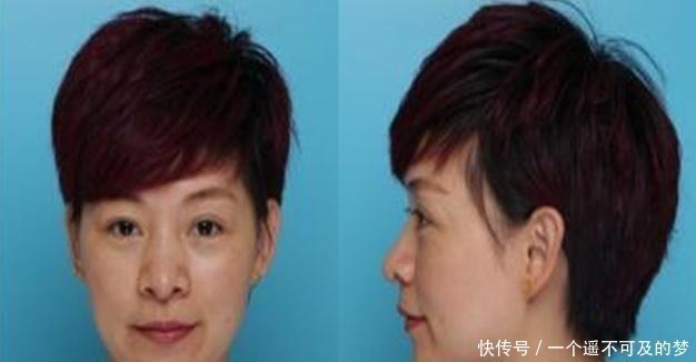 玻尿酸|那些打过“玻尿酸”的人,容貌会有什么变化还好及时知道了!