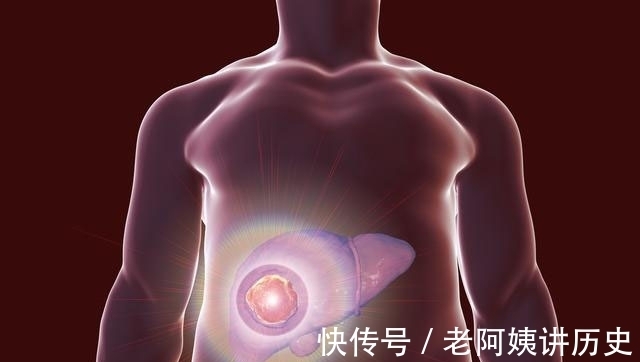 肝癌|患上乙肝要终生预防两个重病，一个是肝硬化，一个是肝癌，都致命