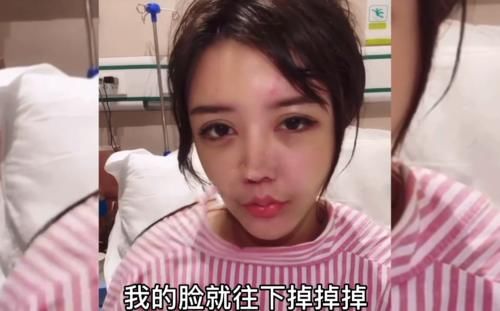 面部|22岁韩安冉面部下垂，多次修复鼻子再无法动刀，越整越像“僵尸脸”