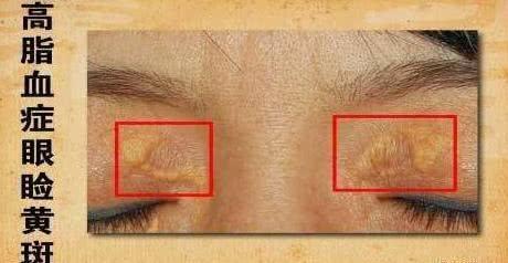 丰隆穴|血脂高的人，眼睛可能有3个症状，若没有，说明血脂控制的还不错