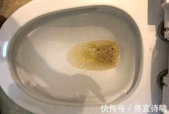 口渴|糖尿病“恶化”的5个信号，千万别不当回事儿