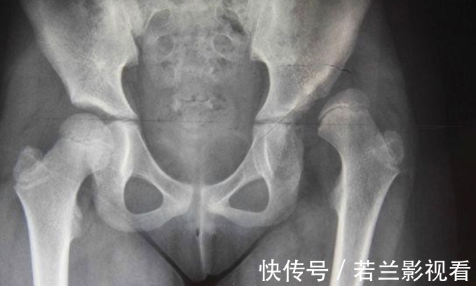 先天性髋关节脱位|这才是宝宝正常会走路的时间,过晚可能与疾病有关!