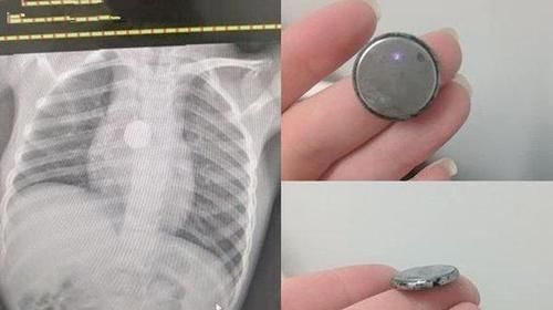 木质类|6岁女童得怪病突然暴瘦,检查后医生让摘项链,妈妈:哪里有项链