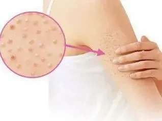 美颜都P不掉的“鸡皮肤”，要怎么救？这篇让你全身“纵享丝滑”