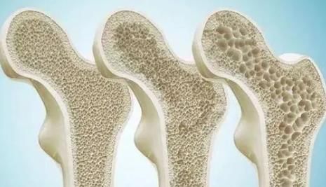 骨骼|茄子是骨质疏松的“发物”?医生:想要养骨,4种食物尽量远离