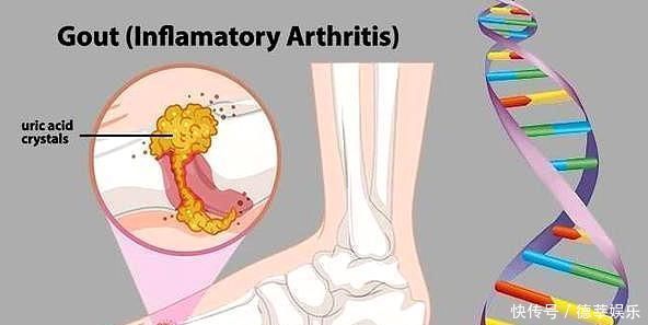 痛风就是吃出来的有些因素也许您想不到医生辟谣给您说清楚