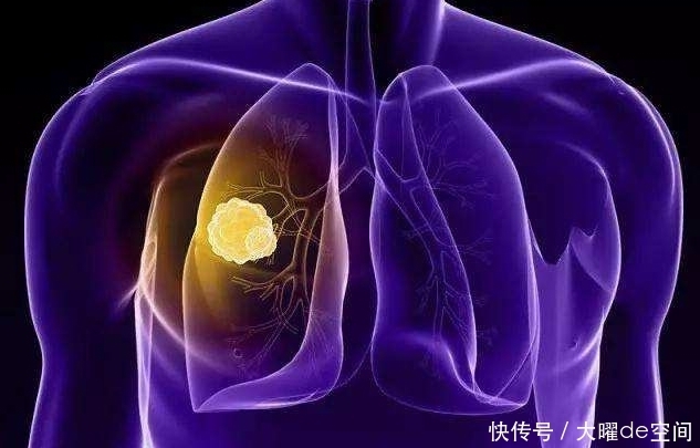 都说肺癌活不过3年,可他已经抗癌10年,这些经验学到了能救命