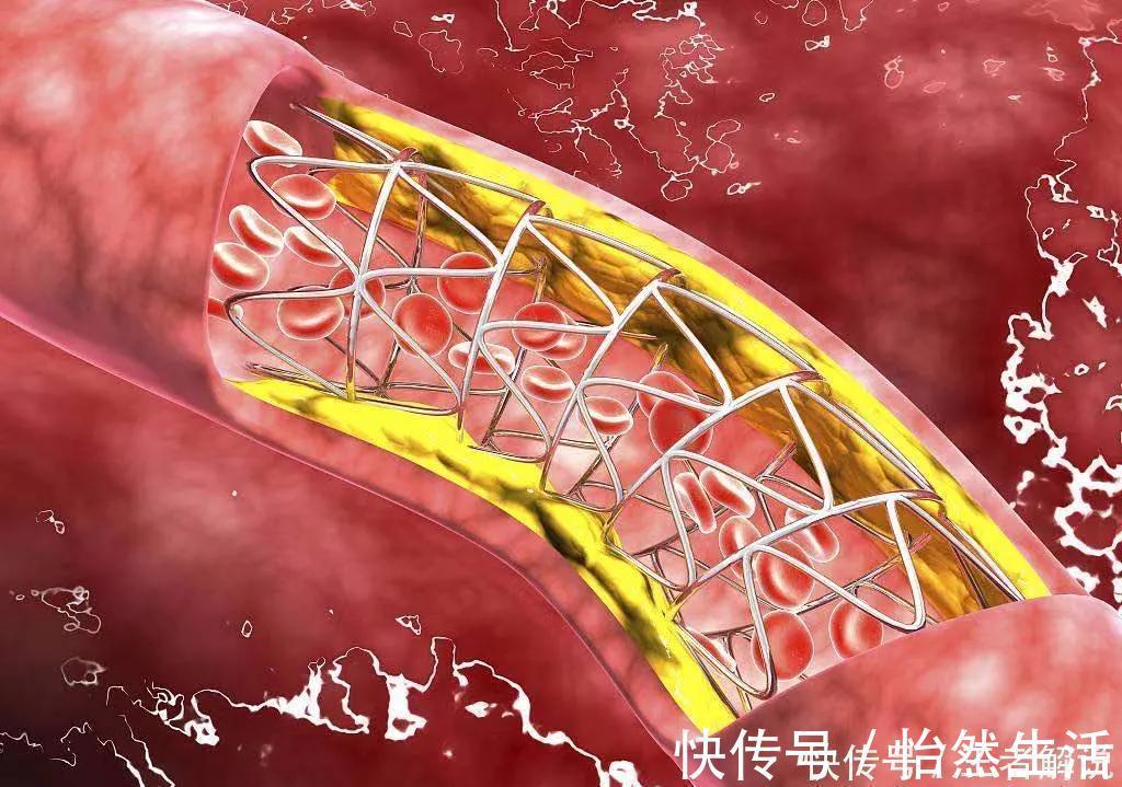 药物|为什么放支架后要吃氯吡格雷或替格瑞洛？