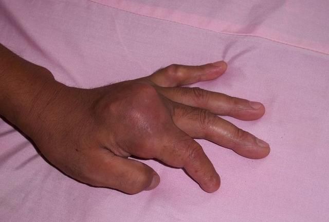 一张只有2味药的痛风治愈方,造福了无数人,从根本上解决痛风