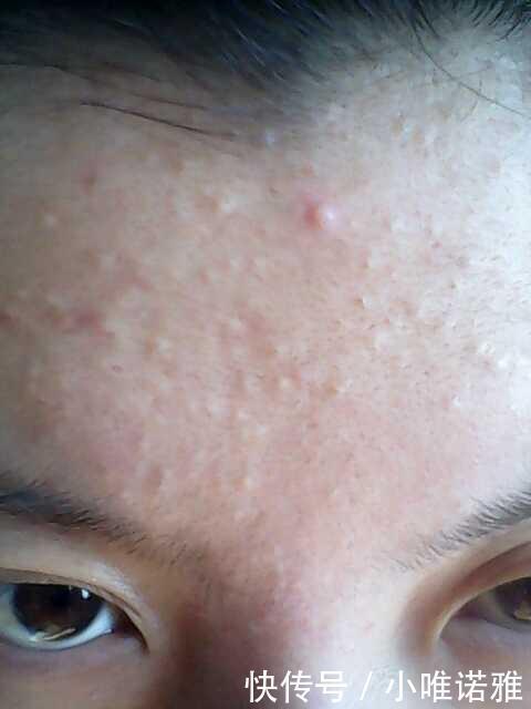 脸上都是小米粒痘痘怎么办唯诺雅教你快速简单的方法