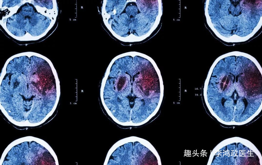 感冒|女性头晕2天以为感冒，第3天突然猝死，医生本可治疗，错过时间
