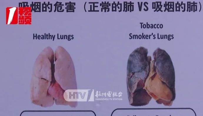 医学科|这种病全国1亿人有，死因第三位！杭州一小伙才26岁就得了，原因查到了↘