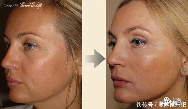 半个娱乐圈女明星脸上都有的这个坑，真的是线雕的锅吗？