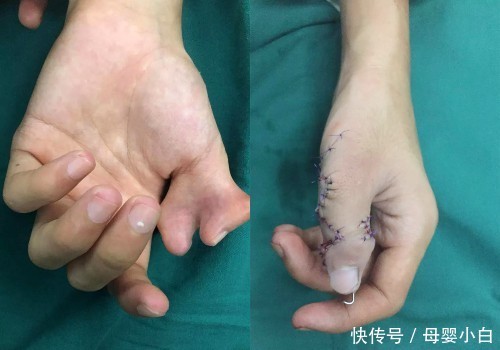 手指蟹钳畸形几种类型图片