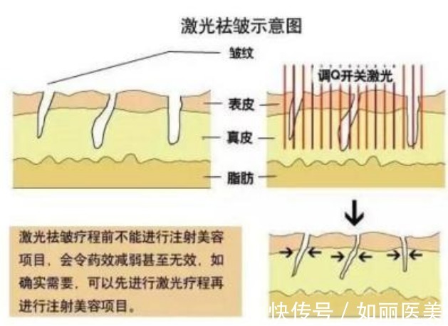 防晒 点阵激光除皱要做几次？点阵激光除皱术后怎么护理？要做好这3点！